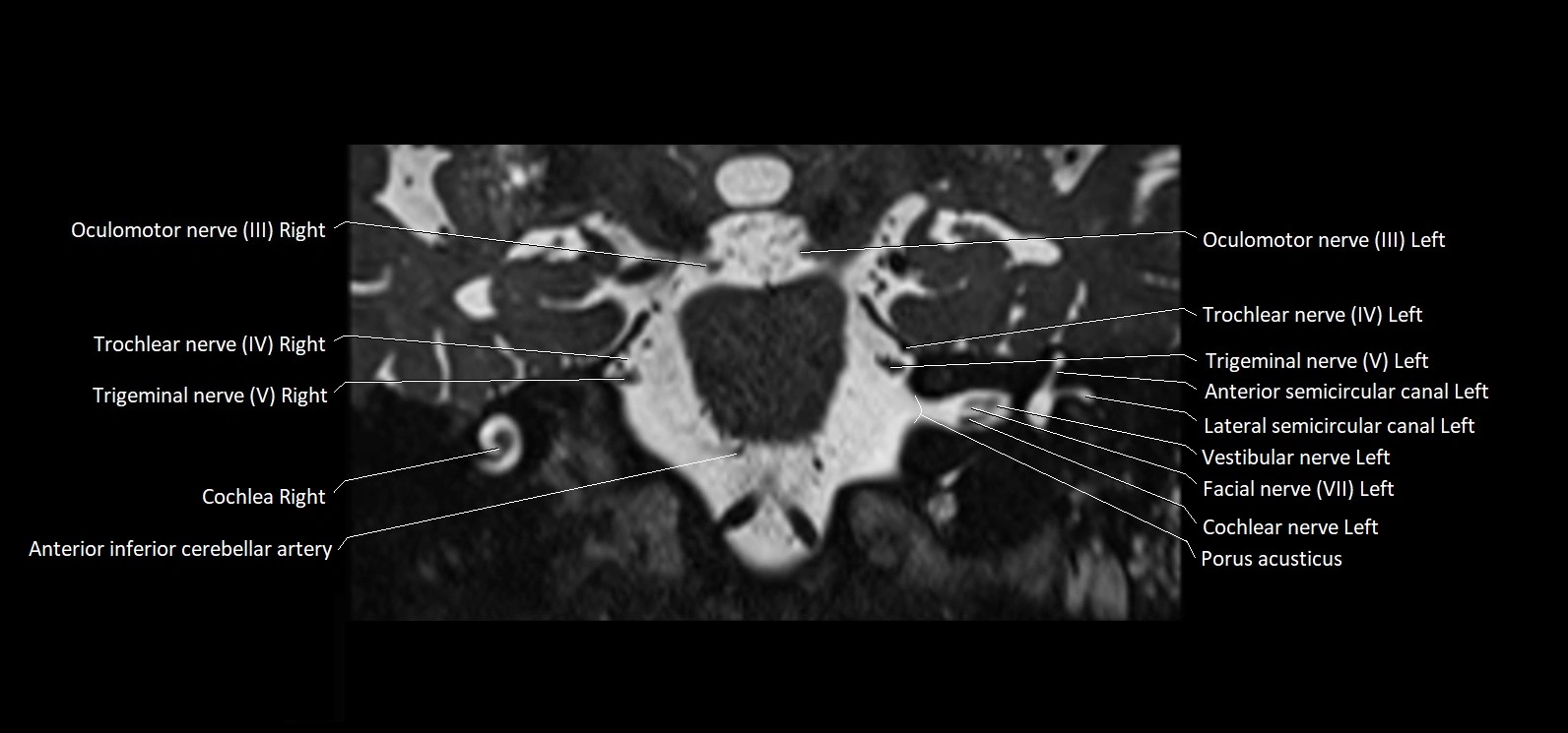 Cranial nerve cross sectional anatomy coronal 3T MRI image 39.webp